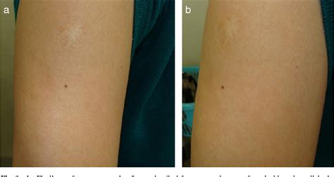 A Case Of Fat Injection For Treating Subcutaneous Atrophy Caused By