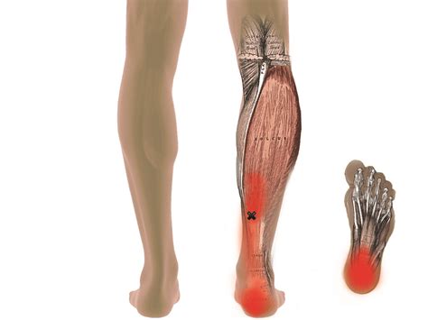 How To Treat Calf Trigger Points