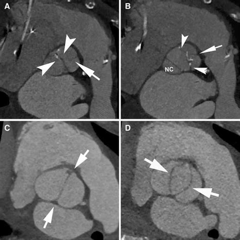Ct Assessment Of Bicuspid Aortic Valve A Sievers Type 1 L R Bav