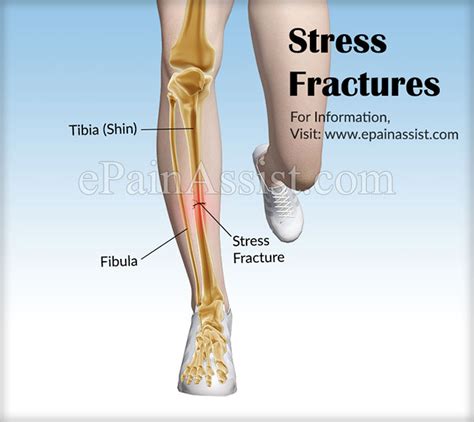 Stress Fracturescausessymptomstreatmentrecoverycomplications