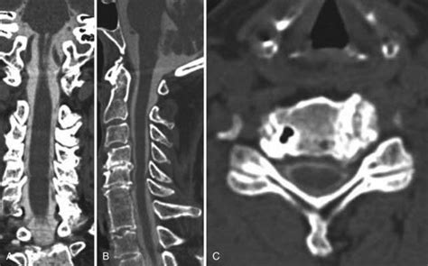 Radiology Of The Spine Neupsy Key
