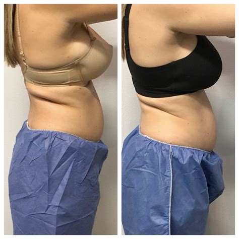 Coolsculpting Before And After Results And Review Fat Freezing Results