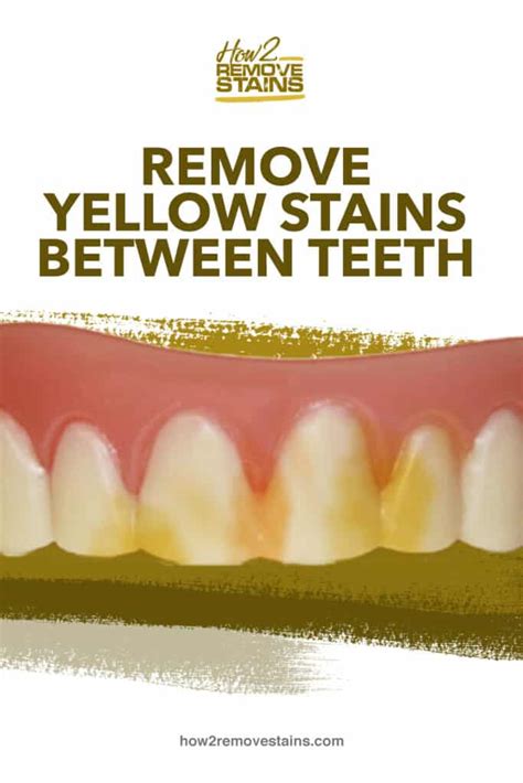 100% results guaranteed · no more coffee stains · free us shipping How to remove yellow stains between teeth  Detailed Answer 