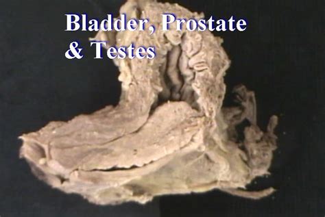 Pathology Bladder Prostate And Testes Anatomy Guy