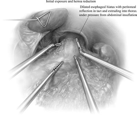 References In Robotic Assisted Giant Paraesophageal Hernia Repair And