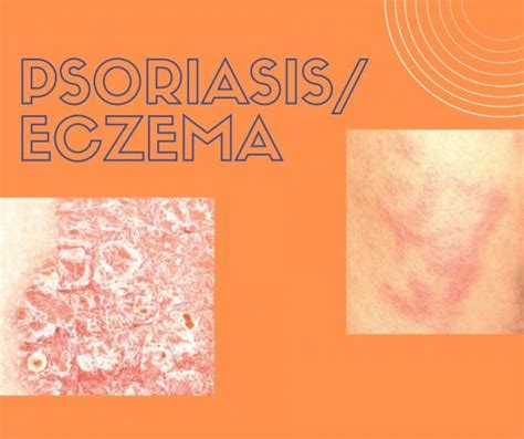 ¿cuál Es La Diferencia Entre Eczema Y Psoriasis