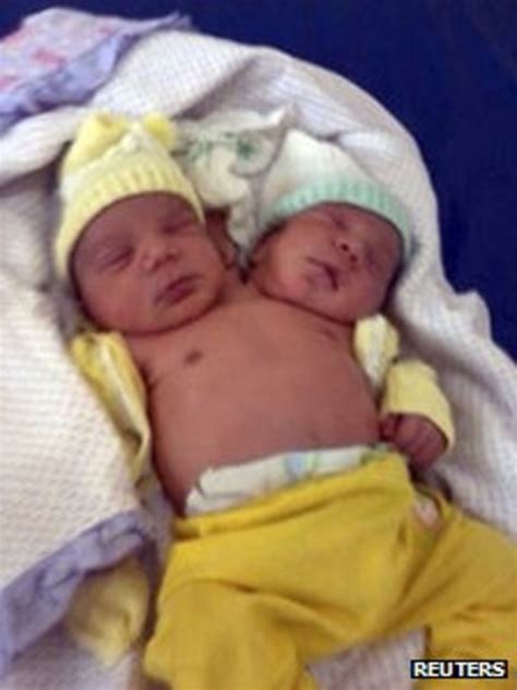 Twins Born In Brazil With Two Heads One Heart Bbc News