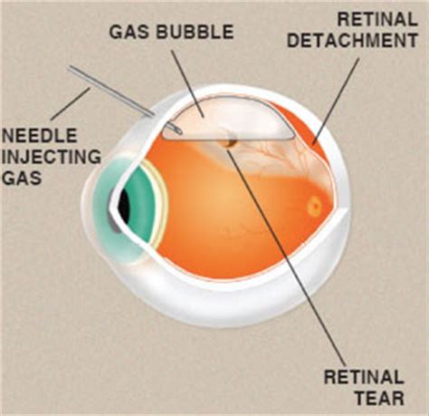 Previous other eye disease or inflammation. Will oligo-TetraPEG be the new jelly of eye surgery ...