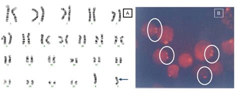 Diversity Of Sex Chromosome Abnormalities In A Cohort Of 95 Indonesian Patients With Monosomy X