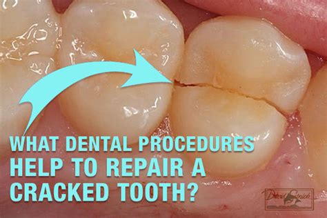 What Dental Procedures Help To Repair A Cracked Tooth Cracked Tooth