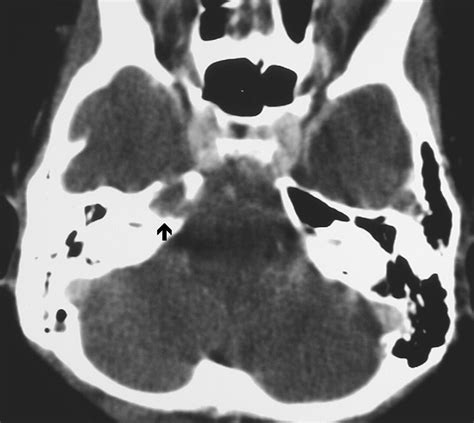Imaging Of Complications Of Acute Mastoiditis In Children Radiographics