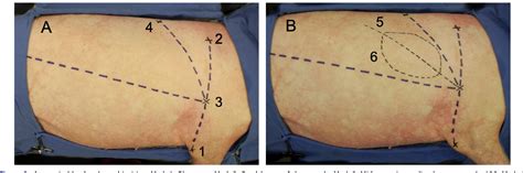 Figure 4 From Latissimus Dorsi Myocutaneous Flap Procedure In A Swine