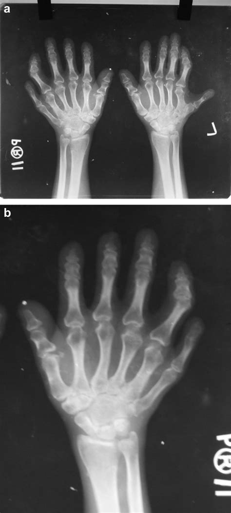 E A And B X Ray Of Wrist Joint Showing Fusion Of Carpal Bones And