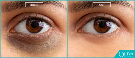 How To Get Rid Of Dark Circles Under The Eyes Treatment And Cost