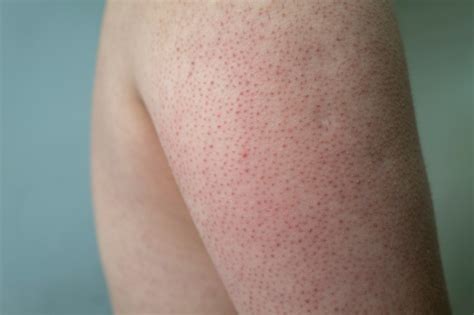 Kokeratosis Pilaris Aura Dermatology