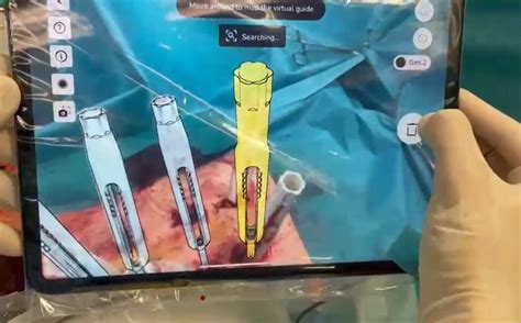 Neo Medical Raises 20 Million For Its Ar Technology For Spine Surgery Bioalps