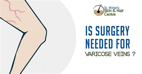 Varicose Veins Treatment With Surgery