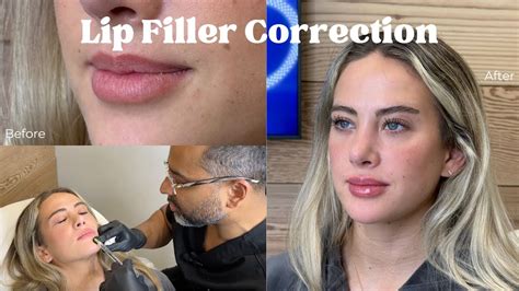Lip Filler Correction Youtube