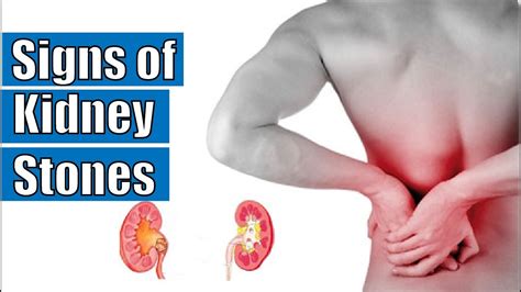 Signs Of Kidney Stones Symptoms Of Kidney Stones Youtube