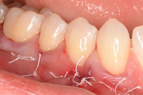 Gum Health Faq Preston Dental