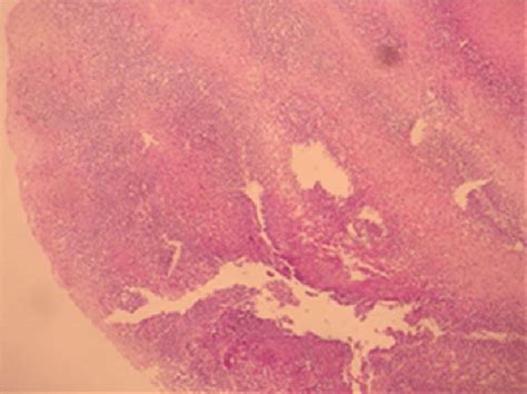 Eosinophilic Infiltration In H E Â10 Esophagus Mucosa Download
