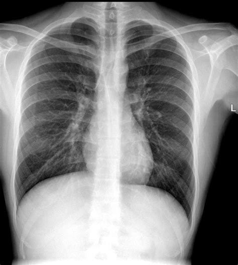 Anterior And Posterior Junctional Lines Chest X Ray Radiology Case 3960 Hot Sex Picture