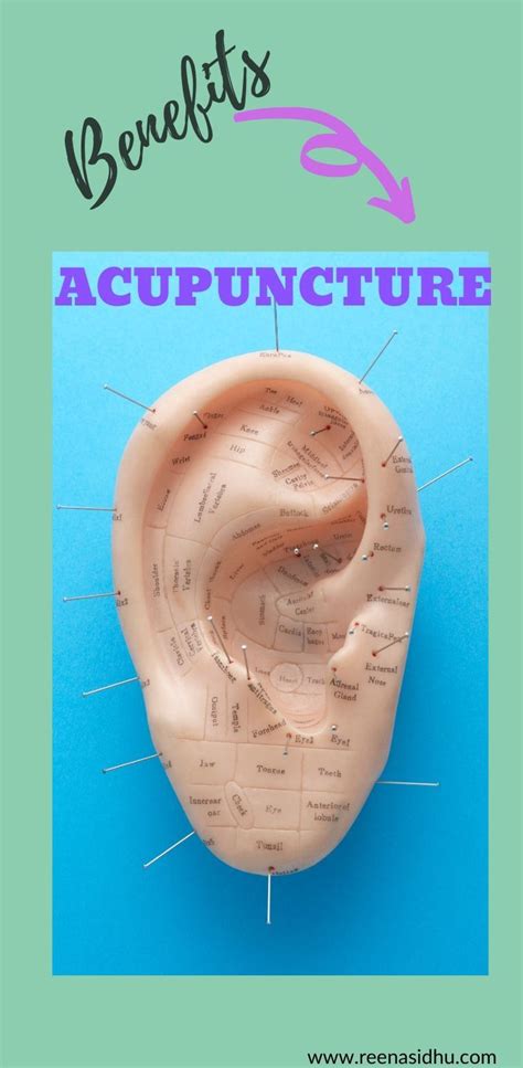The Many Benefits Of Acupuncture In 2020 Acupuncture Benefit Homeopathy