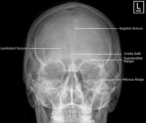 Skull Radiographic Anatomy Wikiradiography Radiology Facial Bones