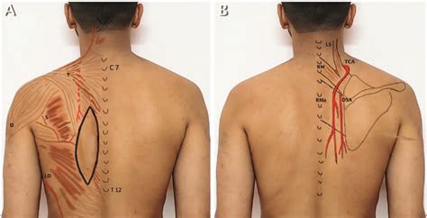 (A) Image showing important landmarks for trapezius ...