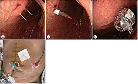 Clinical Outcomes Of Percutaneous Endoscopic Gastrostomy