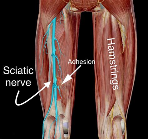 Trapped Sciatic Nerve In Or Around Hamstrings Chiropractic