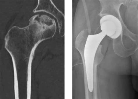 Collapsed Femoral Head