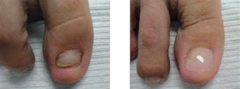 Toenail Reconstruction Aurora Foot Clinic Keryflex Aurora On