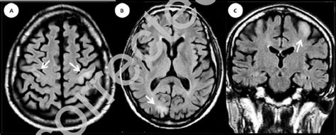 Brain Mri Flair Sequence Axial Ab And Coronal C Sections