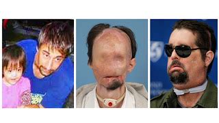 Jamie nash survived a car crash with 70 per cent burns fort worth, a texas man who became the first person in the us to. South Africa & The Media: Man shows off first full face ...