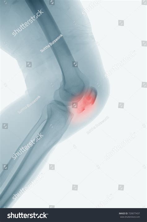 Xray Image Knee Lateral View Showing Stock Photo 729077437 Shutterstock