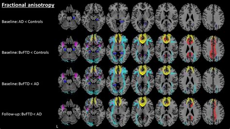 Early Diagnosis Of Dementia With Mri European Radiology