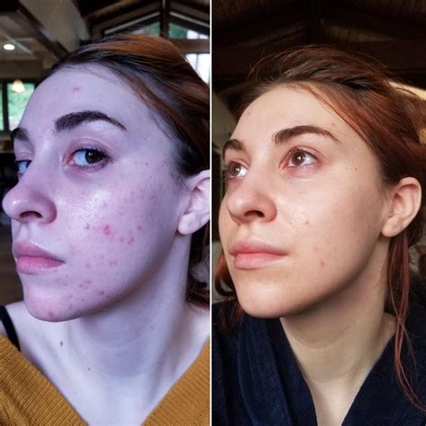 7 Months On Spironolactone Doxycycline And Tretinoin 0025 I Never