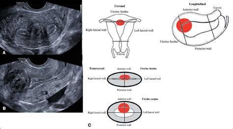 Scielo Brasil Reporting Of Uterine Fibroids On Ultrasound