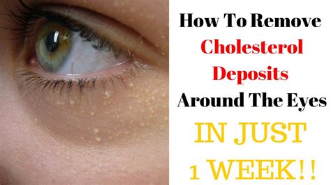 Say Goodbye To Cholesterol Deposits Around The Eyes Remove