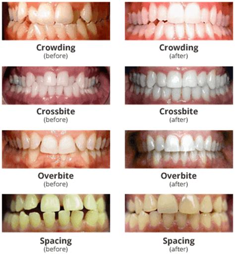 Crowding Teeth Invisalign Invisalign Charlotte Invisalign Crowded