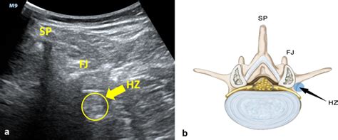 Ultrasound Image And Diagrammatic Sketch Of The Lumbar And Hyperechoic