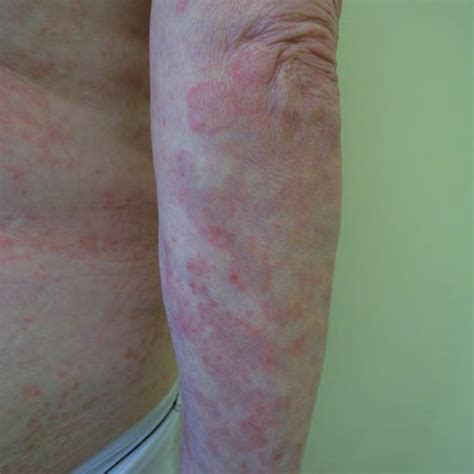 Typical Palpable Purpura On The Legs Of A Patient With Iga Vasculitis
