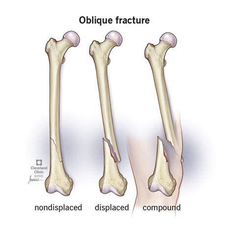 Treatment Of Bone Fractures Bone Fracture With Displa