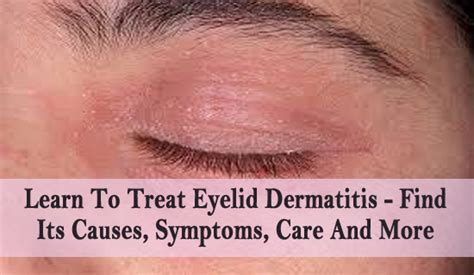 Eczemasymptomsandtreatment Eyelid Dermatitis Eczema On Eyelids Eye