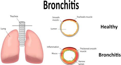 O obstructive atelectasis, when airflow is decreased (over atelectasis zone). Bronchitis Symptoms | Bronchitis Treatment & Causes ...