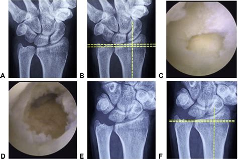 Arthroscopic Wafer Procedure Versus Ulnar Shortening Osteotomy For