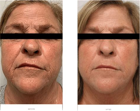 Morpheus8 Before And After Face Neck Jowls Under Eyes Morpheus8