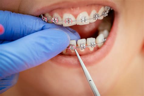 5 Steps To Take If You Have A Broken Bracket On Your Braces