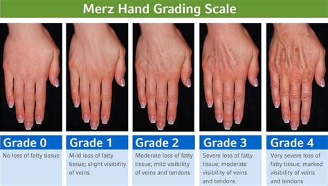 Hand Rejuvenation Treatment Pinnacle Dermatology